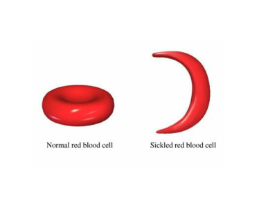 Shape of Sickle cell with abnormal hemoglobin